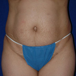 Tummy Tuck - Before