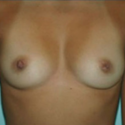 Breast Augmentation - Before