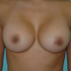 Breast Augmentation - After