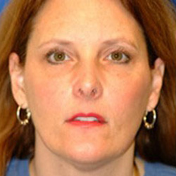 Brow & Face Lift - Before