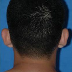 Otoplasty (Ears) - Before