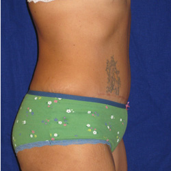 Tummy Tuck - After