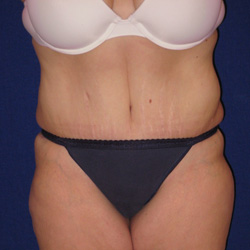 Tummy Tuck - After