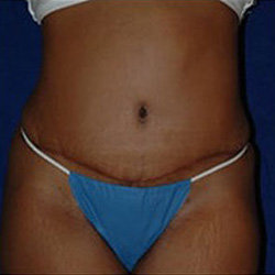 Tummy Tuck - After